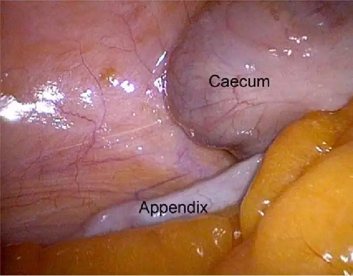 laparoscopic view of the vermiform appendix pelvic position
