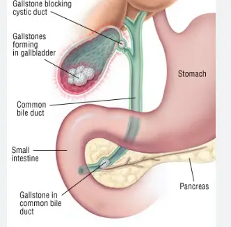 gallstones forming in gallblader