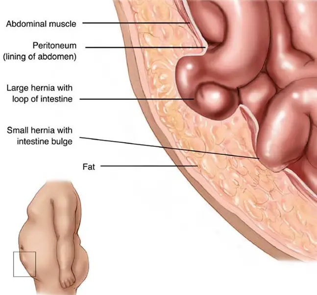 hernia symptoms graphic lg