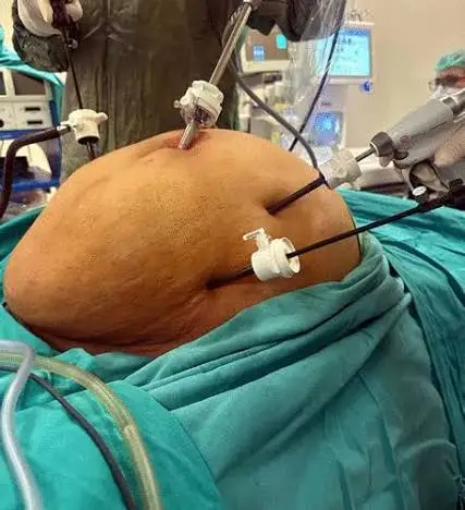 laparoscopic surgery procedure